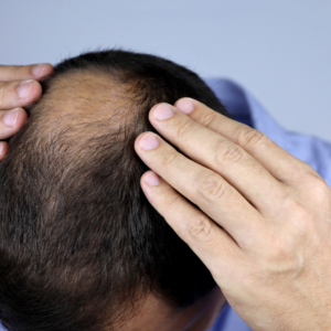 Article: Hair loss Solutions. Pic - "Man touching the top of his balding head."