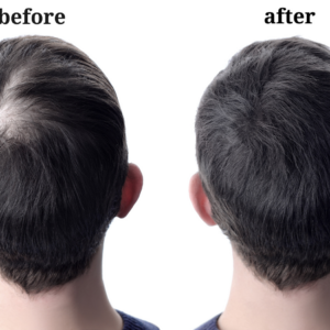 "Before and after images showing hair regrowth on a man's scalp."