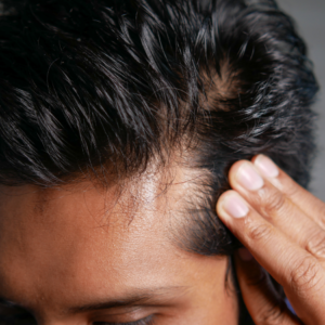 Article: Hair loss Solutions. Pic - "Close-up of a man examining his receding hairline."